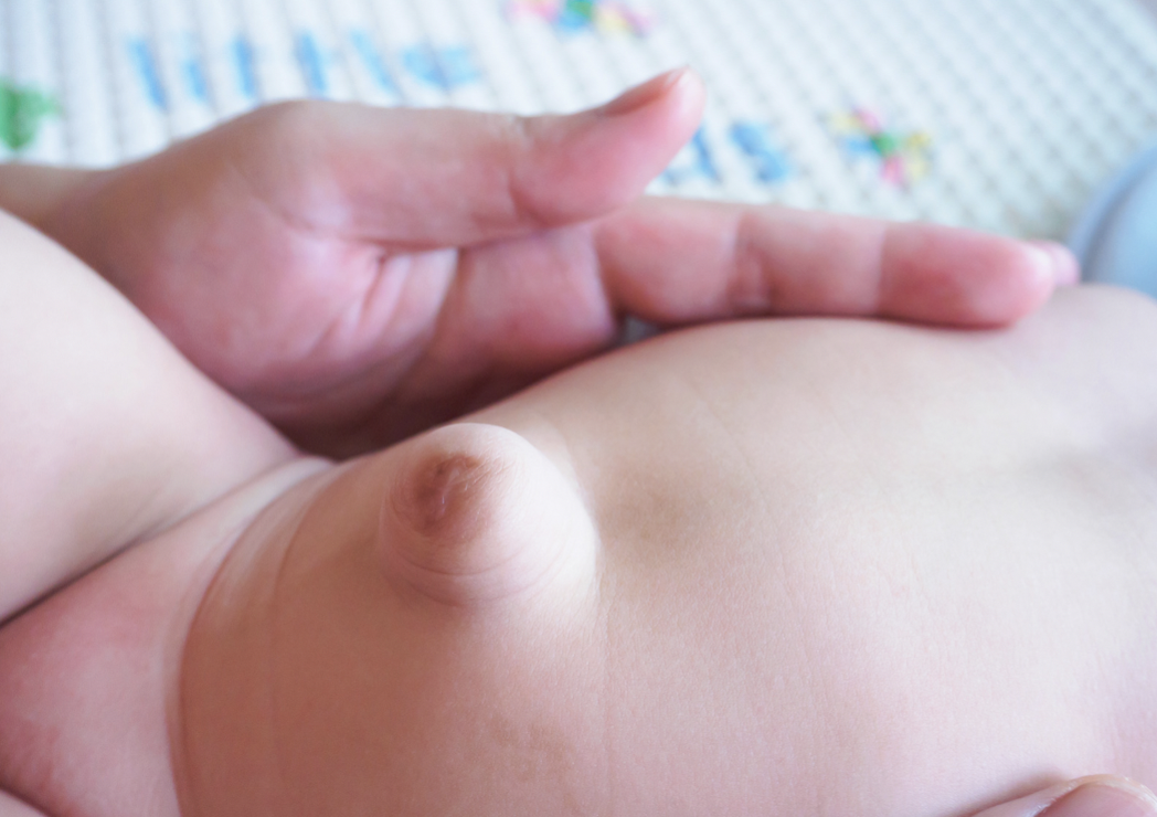 Hernia Umbilikalis